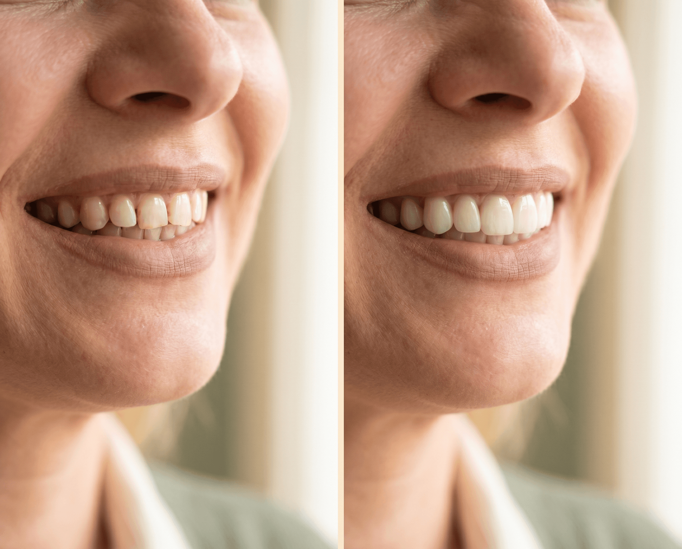 Porcelain veneer smile result by Veda Dental Aesthetics